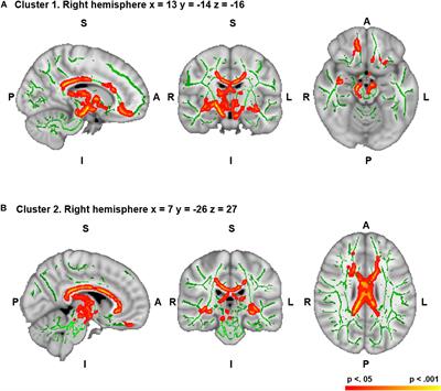 Brain White Matter Correlates of Creativity in Schizophrenia: A Diffusion Tensor Imaging Study